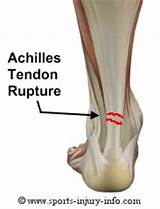Pictures of What Is The Recovery Time For A Torn Achilles Tendon