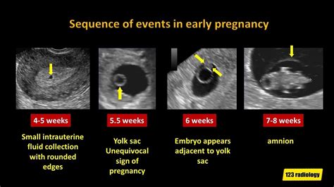 Early Pregnancy Failure A Simplified Ultrasound Approach Youtube