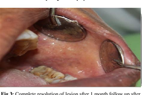 Figure 3 From Oral Lichenoid Contact Lesion To Amalgam Restoration And