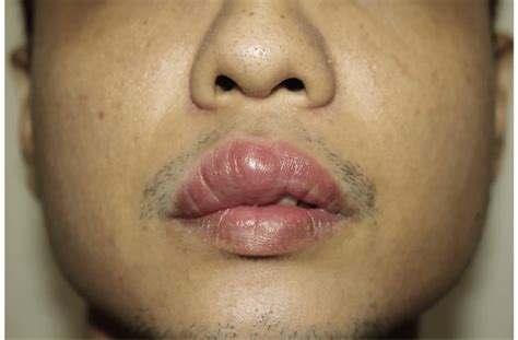 Causes Of Swollen Lips Upper Lipstutorial Org