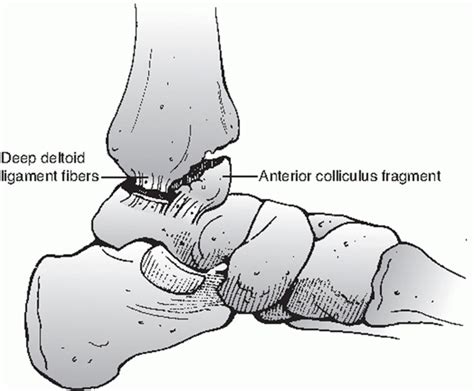 Ankle Fractures Teachme Orthopedics