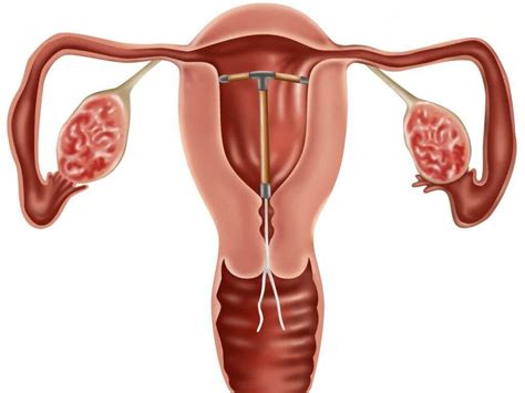 Polycystic Ovary Syndrome What Is Polycystic Ovary Syndrome
