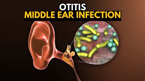 Middle Ear Infection Otitis Media Causes Signs And Symptoms