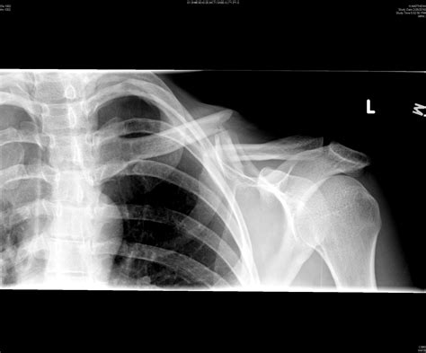 Wait You Want To Admit That Clavicular Fracture — Brown Emergency
