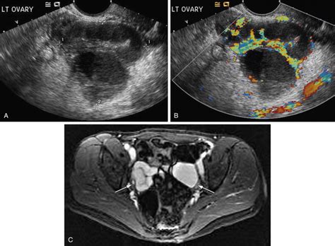 Approach To Imaging The Adnexal Mass Radiology Key
