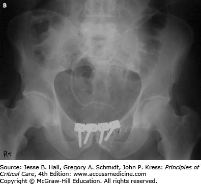 Pelvic Ring Injuries and Extremity Trauma | Anesthesia Key