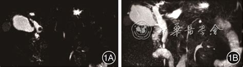 经内镜逆行胰胆管造影术中特殊胆总管穿孔1例