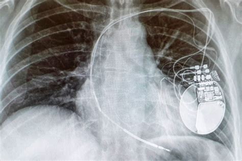 An implantable cardioverter defibrillator (icd) looks similar to a pacemaker, though slightly larger. Steps to Travelling with a Pacemaker or Defibrillator (ICD ...