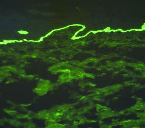 Bullous Pemphigoid Direct Immunofluorescence Study Showing Linear