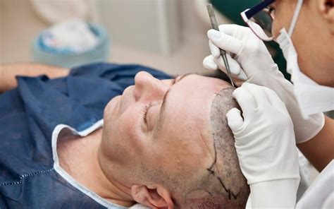Risks And Potential Complications Of A Hair Transplant Best Hair Help