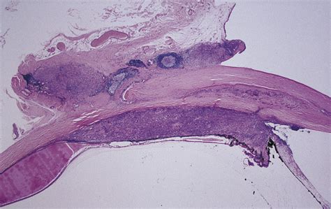 Malignant Melanoma Of The Conjunctiva With Intraocular Extension