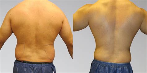 Male Liposuction Before Afters Sono Bello Results