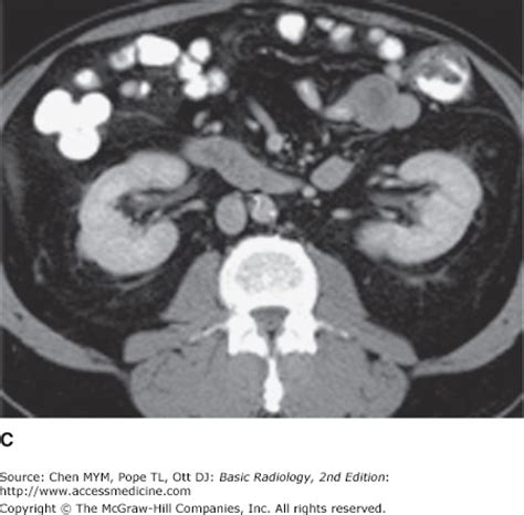 The phases of mdct may help in the differential diagnosis of kidney masses. Chapter 9. Radiology of the Urinary Tract | Radiology Key