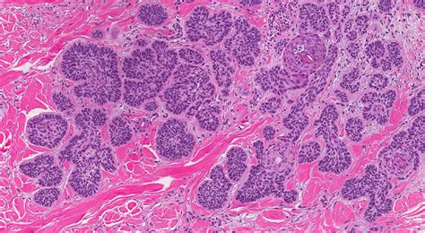 Micronodular Basal Cell Carcinoma Mypathologyreportca