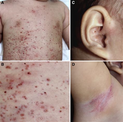 An Uncommon Pediatric Rash Langerhans Cell Histiocytosis The Journal