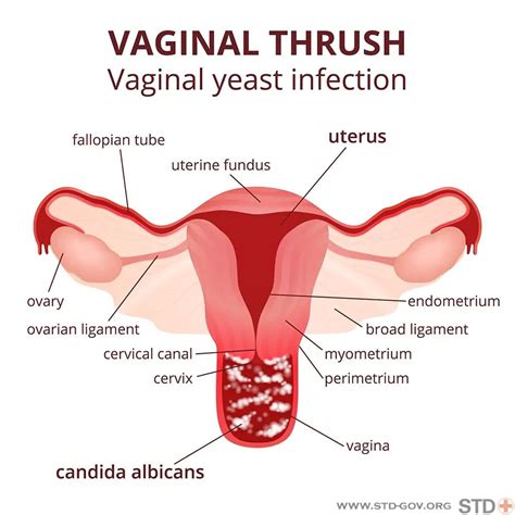 Yeast Infections Natural Remedies Angies Diary