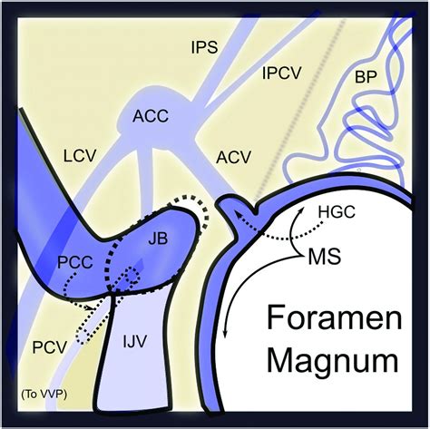 Dural Arteriovenous Fistulas Of The Foramen Magnum Region Clinical