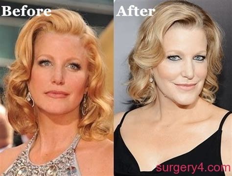 Anna Gunn Plastic Surgery Photos Before And After Surgery4
