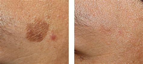 Brown Spots Treatment Melbourne Collins Cosmetic Clinic
