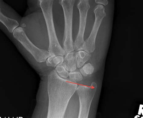 Tfcc, uncategorized, wrist and hand / by dr ravi padmanabhan. Ct Scan Wrist Joint - ct scan machine