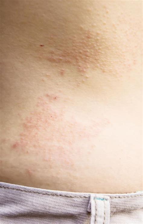 How Do I Use Tea Tree Oil For Eczema With Pictures