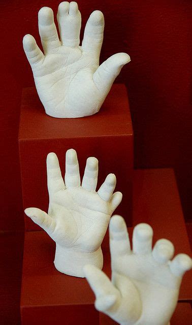 Plaster Casts Of 6 Fingered Hands At The Boston Science Museum In