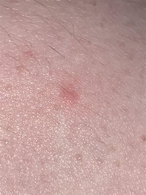 What Is This Bump Pimple Ingrown Hair Folliculitis Bug Bite R