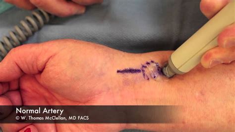 Live Surgery Radial Artery Arteriovenous Fistula Repair Following