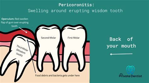 Pericoronitis Wisdom Tooth Pain Explained