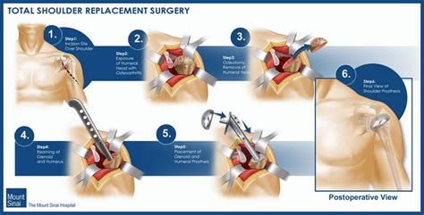 Incision And Drainage Procedure Steps Mapasgmaes