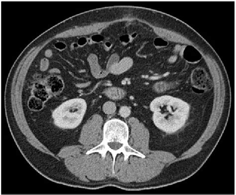 figure 2 from primary abdominal wall abscess by actinomyces and eikenella corrodens a first