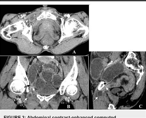 Figure 3 From An Unusual Case Of Obturator Hernia Detected In An