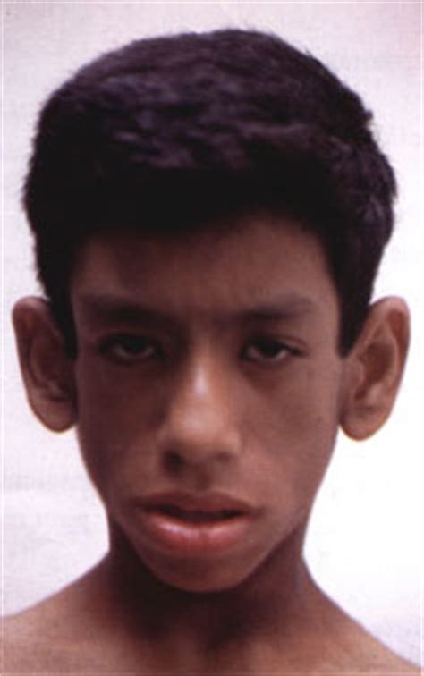 Synonyms of congenital generalized lipodystrophy. Síndrome de Seip Berardinelli