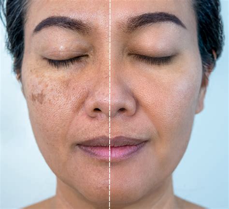 Cosmetic Dermatologist Explains 7 Ways To Treat Melasma