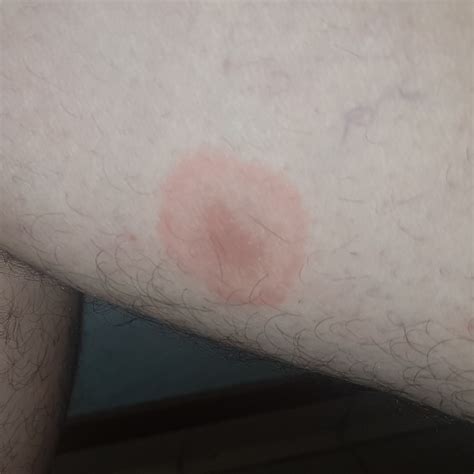 I Have Strange Spots That Have Appeared On My Wrist Arms And Legs