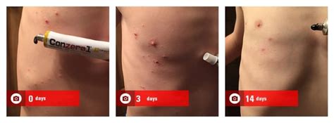 Cantharidin treatment for molluscum contagiosum. Molluscum Contagiosum Pictures. Before & After