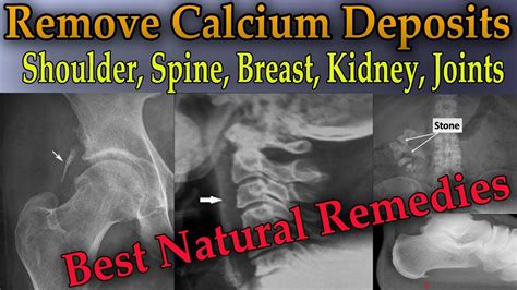 You only need the right cleaning product and special techniques to complete the job. Remove Painful Calcium Deposits From Your Body (3 Best ...