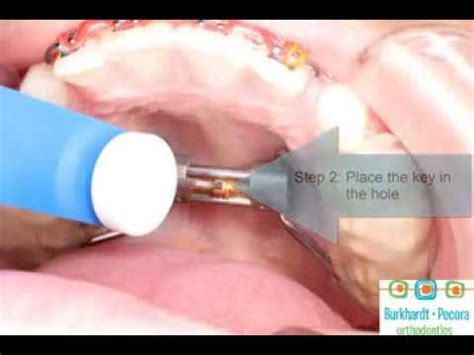 How to activate the expander. Turning a Bonded Rapid Palatal Expander - YouTube