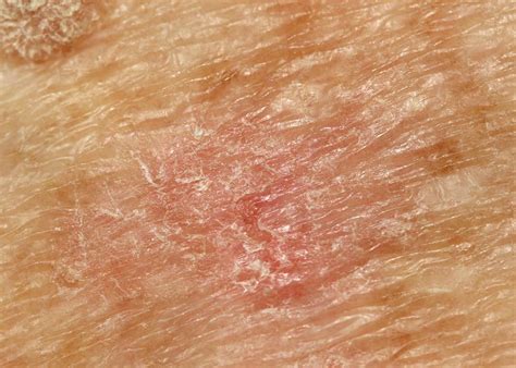 Actinic Keratosis The Most Common Pre Cancer