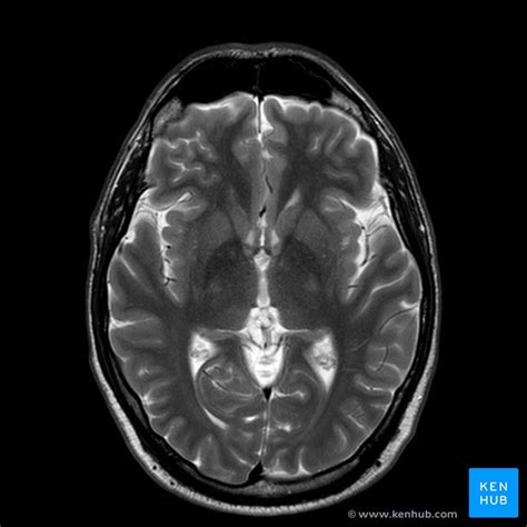 Brain MRI How To Read MRI Brain Scan Kenhub