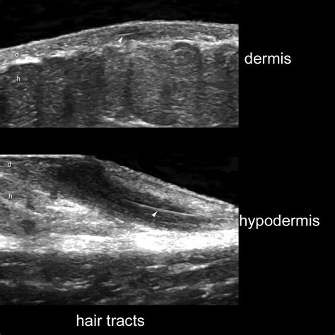 Imaging Of Hidradenitis Suppurativa Dermatologic Clinics