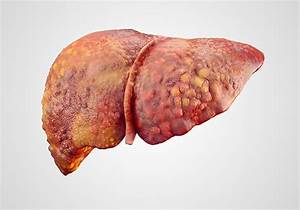 Hepatic Cirrhosis: Causes, Types, Symptoms, Treatment and Prevention - Scope Heal Cirrhosis  
