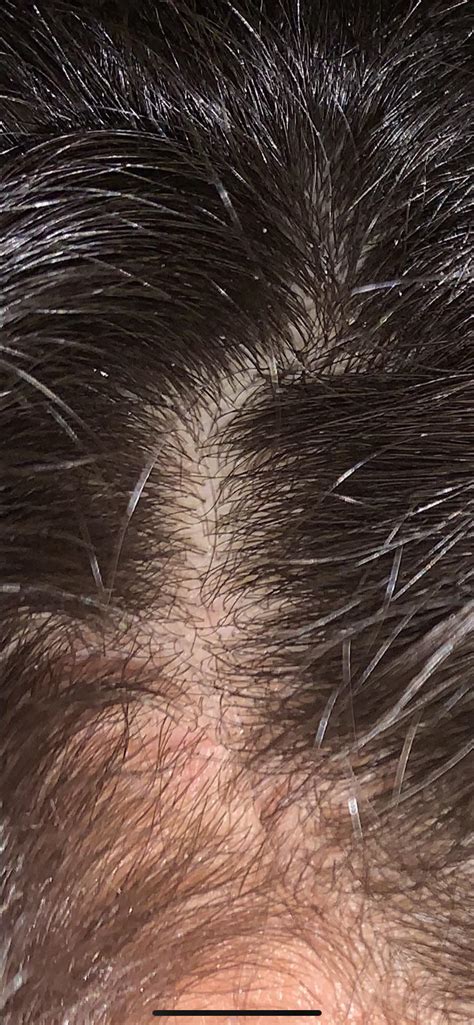 Do These Red Bumps On My Scalp Mean My Aga Is Scarring Anyone