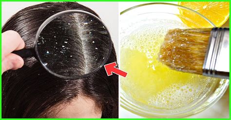 Complete Guide To Cure Dandruff Naturally By Home Remedies Health 24 Life