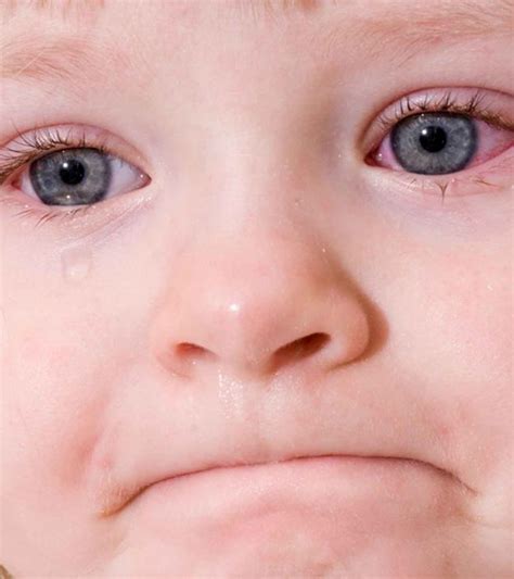 Pink Eye Conjunctivitis In Children 13 Symptoms And Treatment