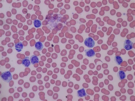 Lymphocytosis Wikiwand