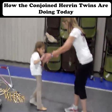 How The Conjoined Herrin Twins Are Doing Today Where Are They Now