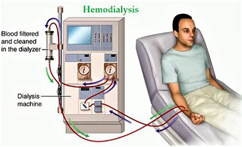 Hemodialysis Procedure Hemodialysis Side Effects