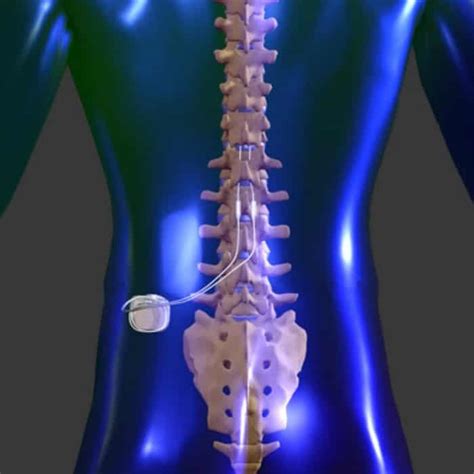 Spinal Cord Stimulator Questions And Answers