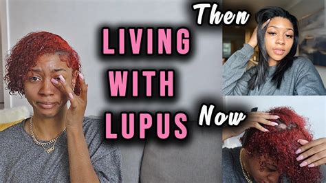 Living With Lupus At Age 23 My Skin And Hair Is Getting Worse